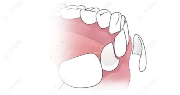 白牙吖全瓷贴面不是杂牌
