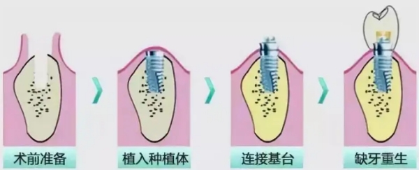 创英种植体和威高种植体材质