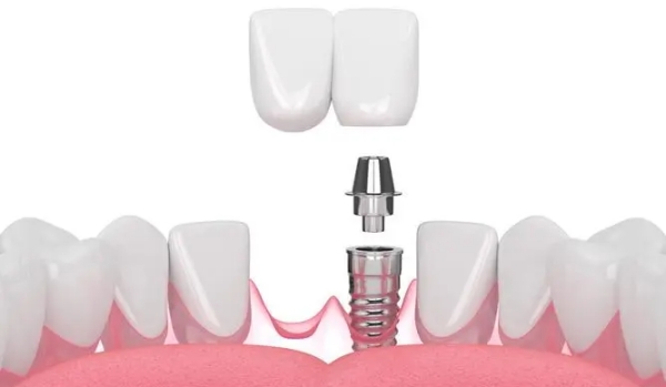 房山便宜的种植牙价格差异