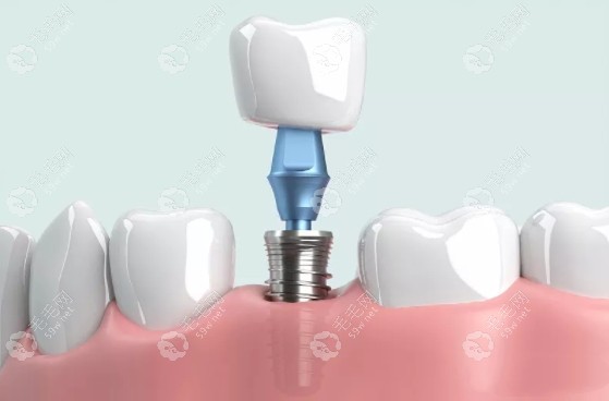 伊宁瑞美泰口腔种植牙 伊宁瑞美泰口腔种植牙