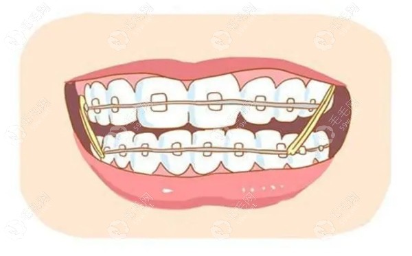唐俊男医生牙齿矫正优势 唐俊男医生牙齿矫正优势