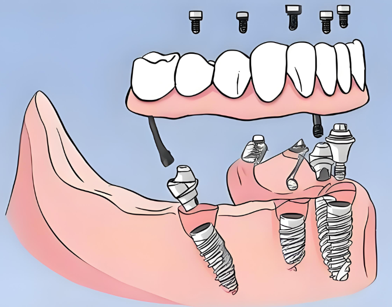 以色列雅定种植牙多少钱一颗？5800-12000元的价格到底值不值？