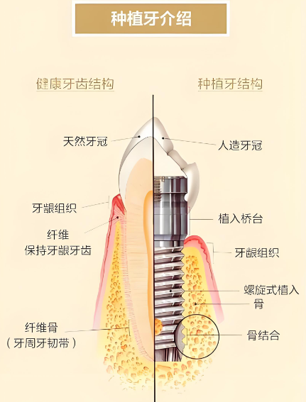 以色列雅定种植牙