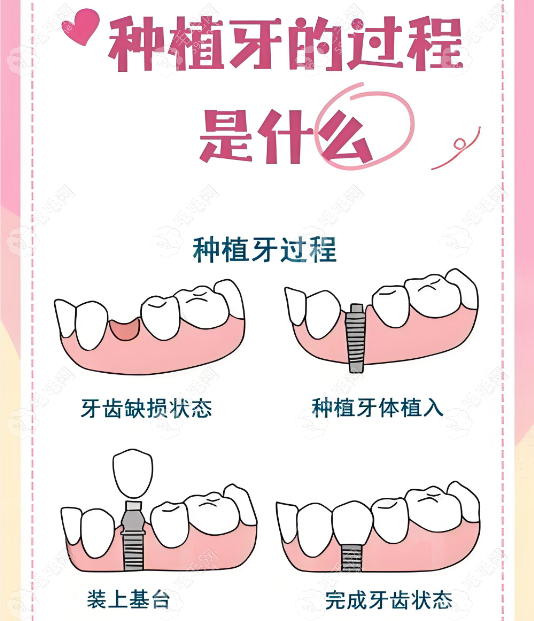 种植牙手术原理