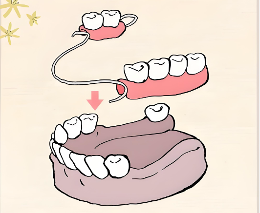 温州活动义齿多少钱