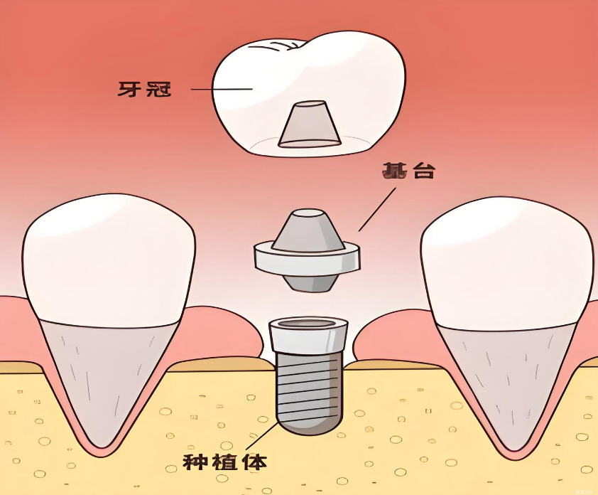 关呈超种牙怎么样