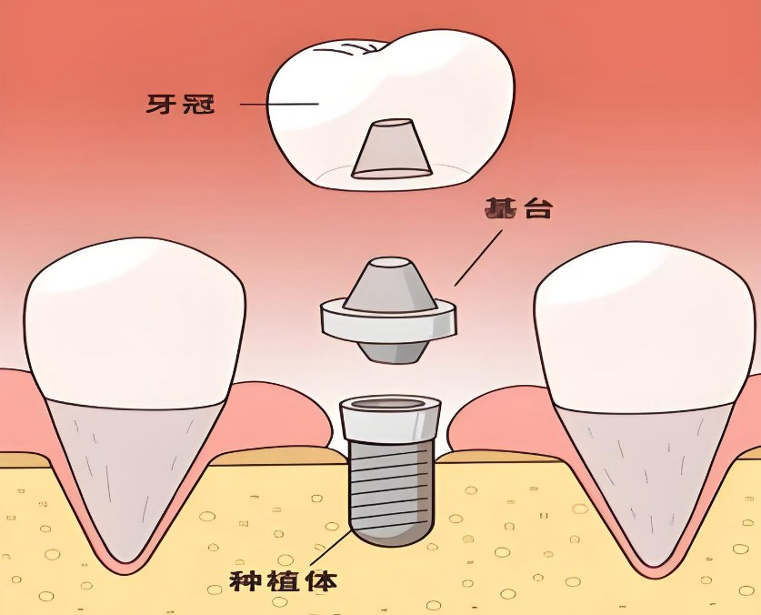 丽水种植牙方案查询www.59w.net