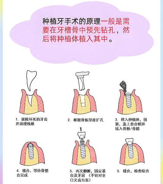 丽水种植牙手术