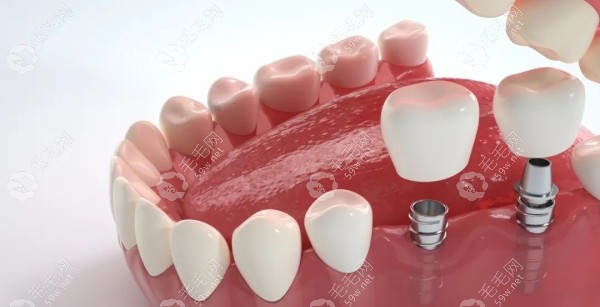 日照文登路口腔种植牙项目 日照文登路口腔种植牙项目