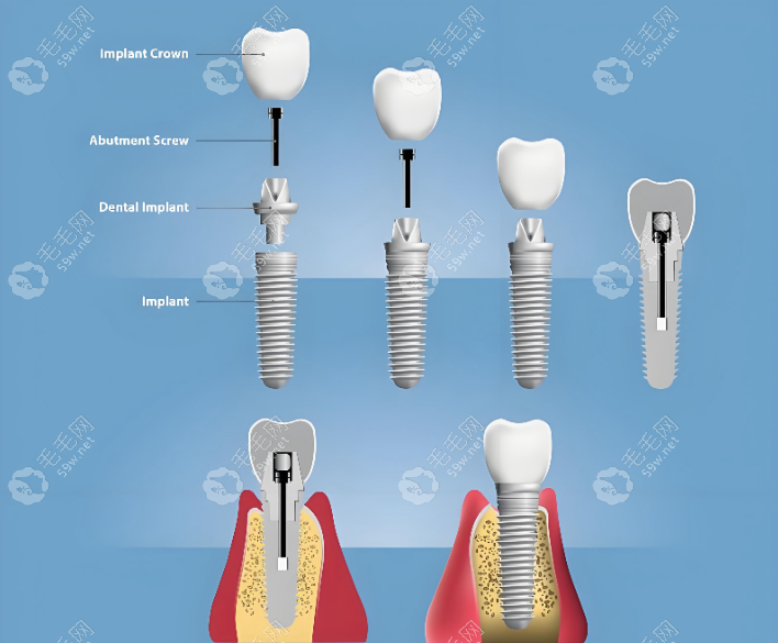 郭傲种植牙怎么样 郭傲种植牙怎么样