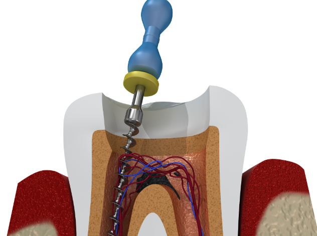 根管治疗后牙齿打桩用什么材料比较好？纤维桩、金属桩、陶瓷桩大揭秘