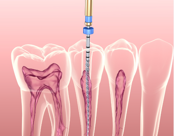 根管治疗后打桩常用材料概述