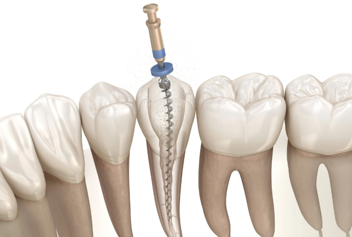根管治疗后牙齿打桩材料如何选择