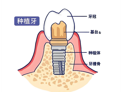 宁波美莱口腔种植牙www.59w.net