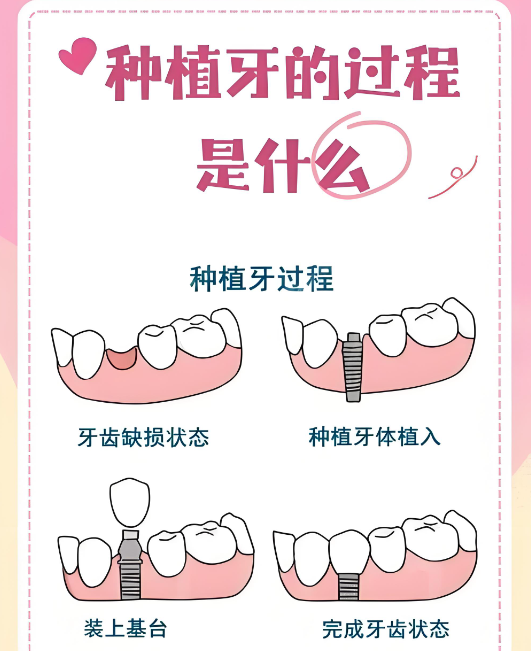 嘉兴种植牙医院如何选www.59w.net