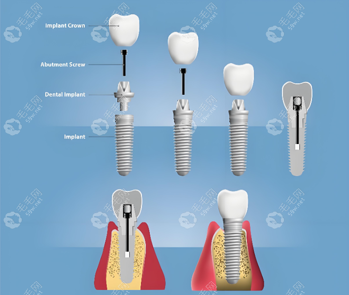 种植牙技术如何www.59w.net