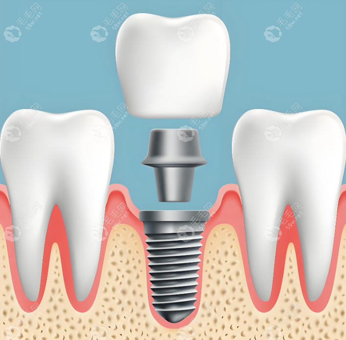 种植牙手术好不好