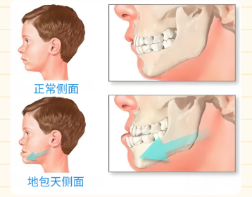 反颌不矫正会怎么样？未治疗顾客牙周病发病率高出3倍