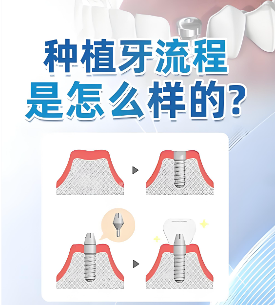 金华种植牙技术如何
