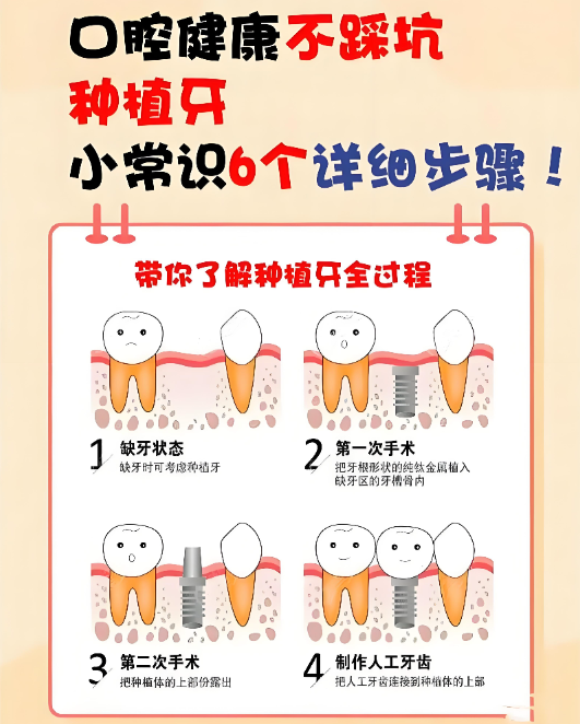 浙江宁波种牙3500有套路吗