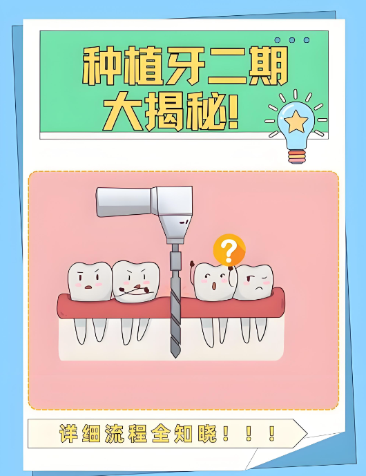 浙江宁波种牙3500贵吗