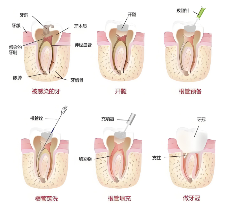 温州根管治疗医院推荐www.59w.net