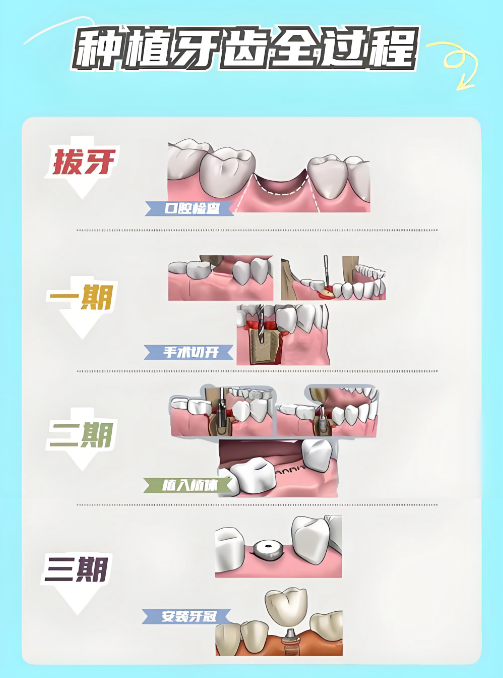 温州俪宣口腔种植牙价格