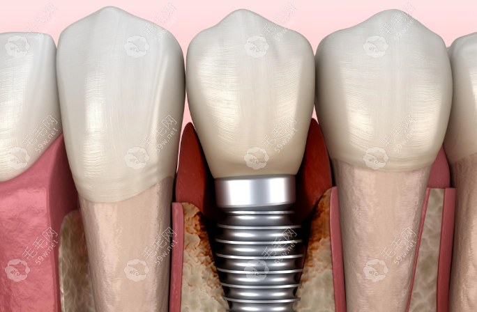 阚医生种植牙示意图 阚医生种植牙示意图