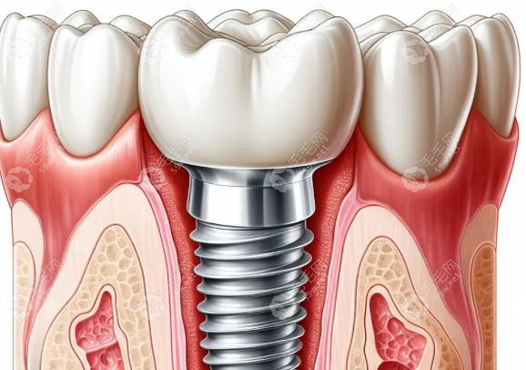 种植牙示意图 种植牙示意图