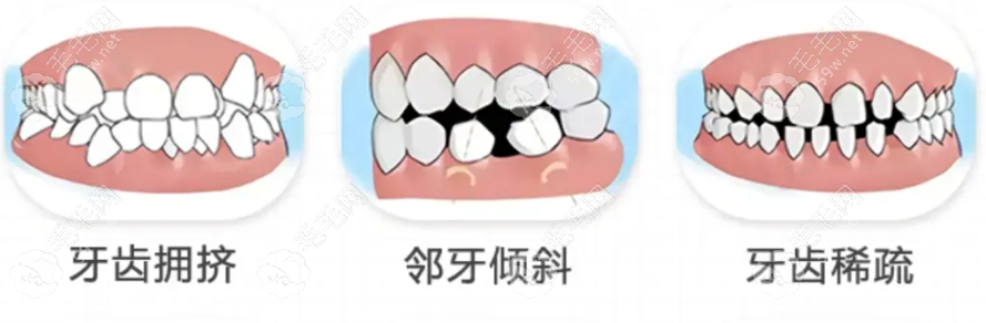 错颌畸形 错颌畸形