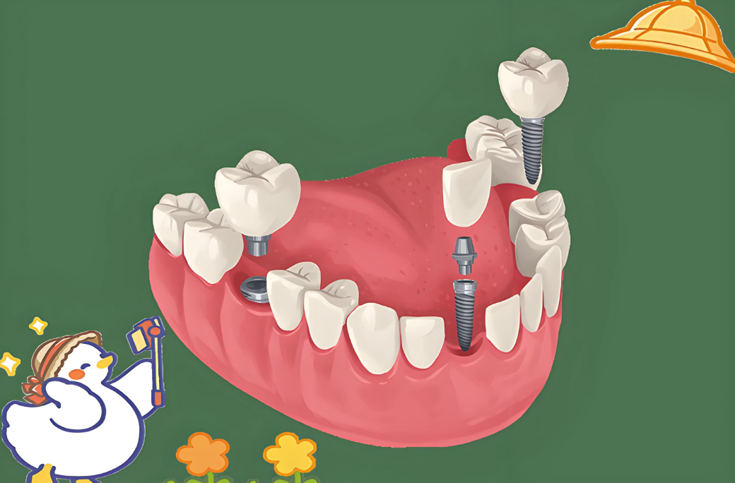 牙齿缺失是做牙套好还是种植好？亲身经历告诉你，牙齿缺失后我为什么放弃了牙套而选择种植？