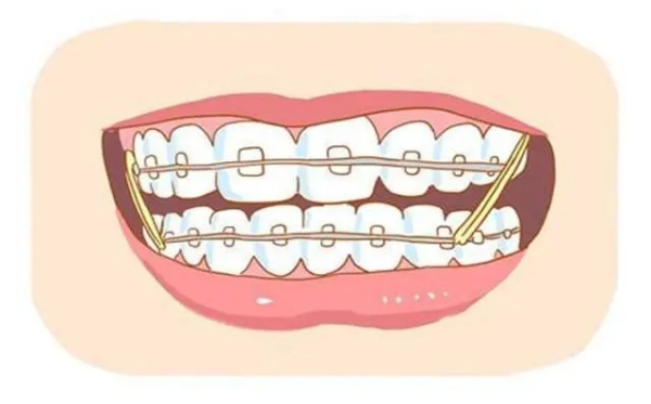 Ao自锁托槽和damon哪个好？价格亲民、想快速矫正等情况选Ao 托槽