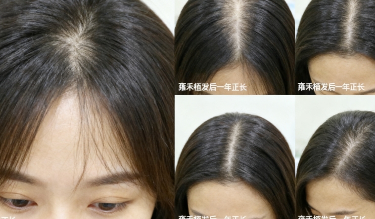 雍禾植发后一年真实案例：从稀疏到浓密，发友记录全年生长变化