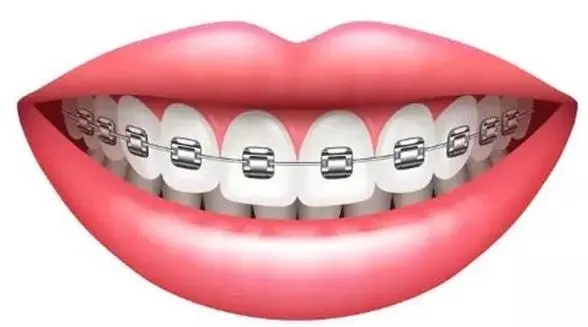 美国ao自锁托槽矫正