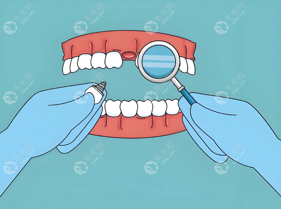 种植牙质量如何www.59w.net