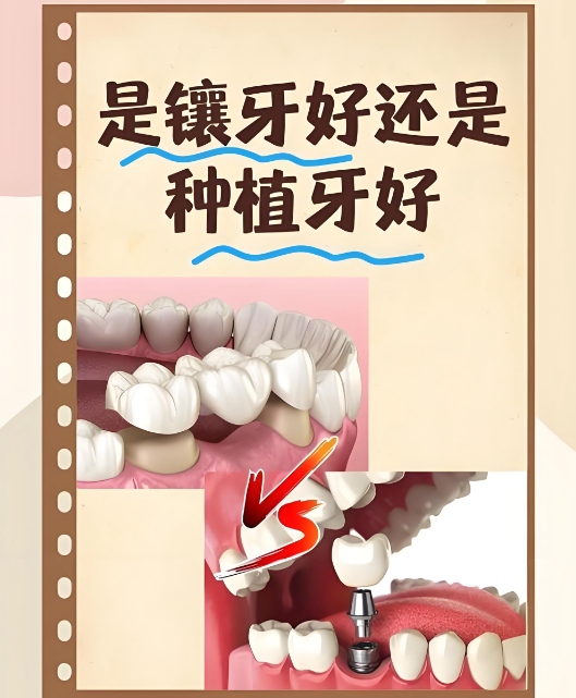 镶牙和种牙的区别图解