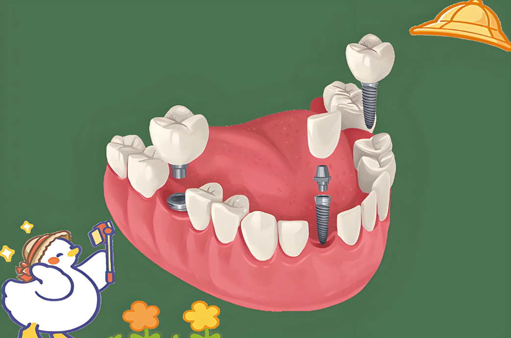 杭州杭嘉口腔浦沿店种牙技术