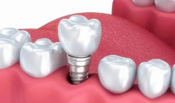 大清西格种植体和奥齿泰哪个好？预算有限、单颗种植选大清西格，复杂情况选奥齿泰