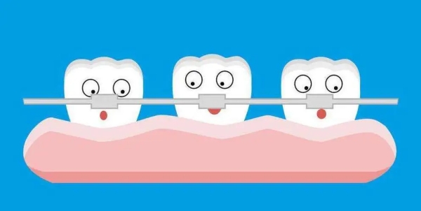 Ao自锁托槽怎么样