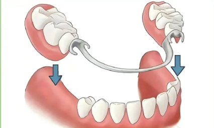 马里兰桥和活动义齿哪个更牢固？从固位原理和适用情况深度分析