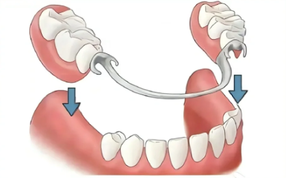 马里兰桥和活动义齿哪个更牢固？马里兰桥