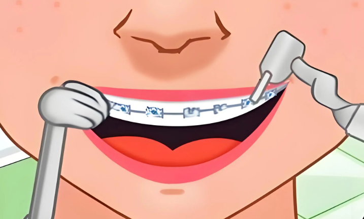 天包地17岁还能矫正么?矫正方式及时间
