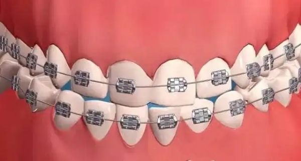 AO托槽属于什么档次www.59w.net