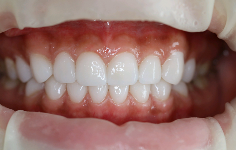 成都牙齿贴片价格常见疑问解答