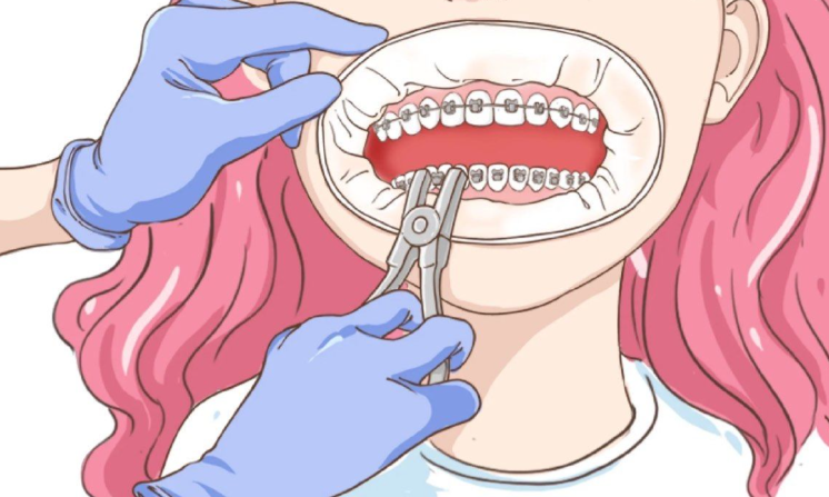 广州柏德口腔矫正价格背后，这些项目特点要知道