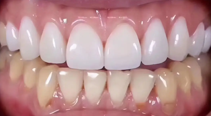 广州牙齿贴面多少钱一颗