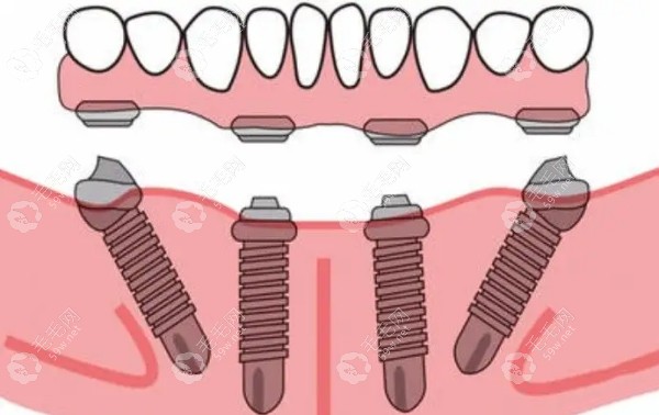 襄城幸福里口腔种植牙