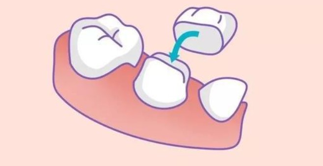 中山德斯口腔种牙价格大揭秘!含多品牌植体费用及即拔即种项目