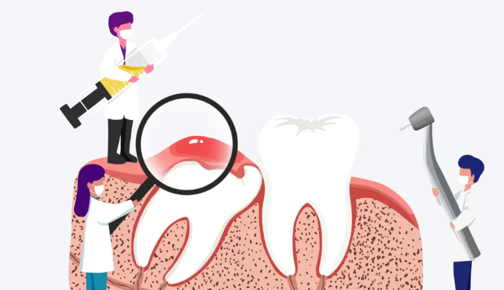 拔烂牙的附加费用及注意事项