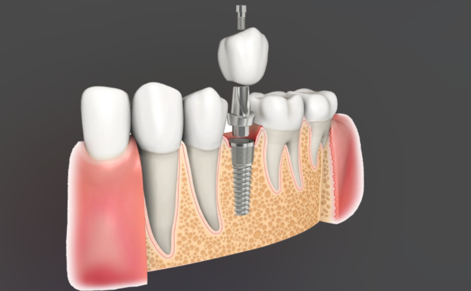 士卓曼美学种植体